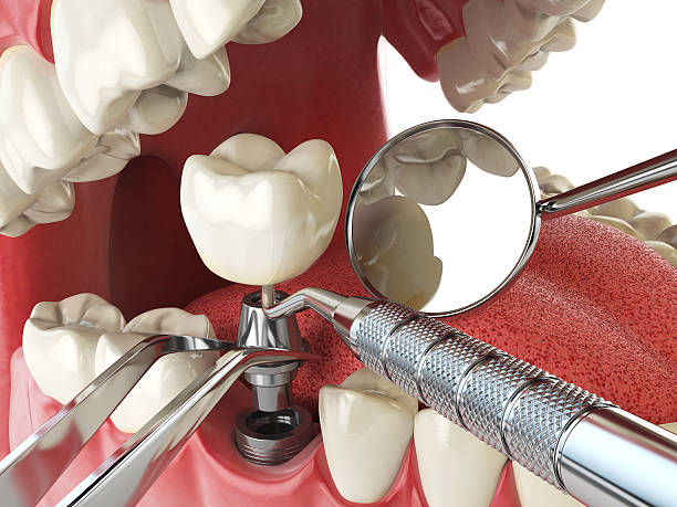 Best Emergency Treatment for Dental Infections or Abscesses in South Windham, CT